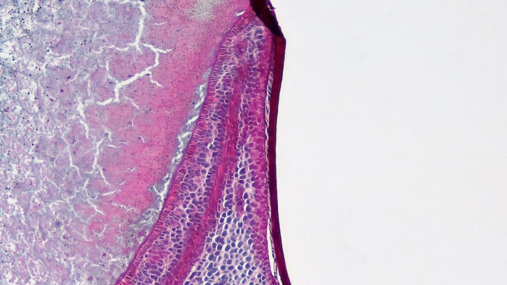 l'hématurie est la présence de sang dans les urines, pouvant indiquer diverses conditions médicales. découvrez les causes, symptômes et traitements possibles.