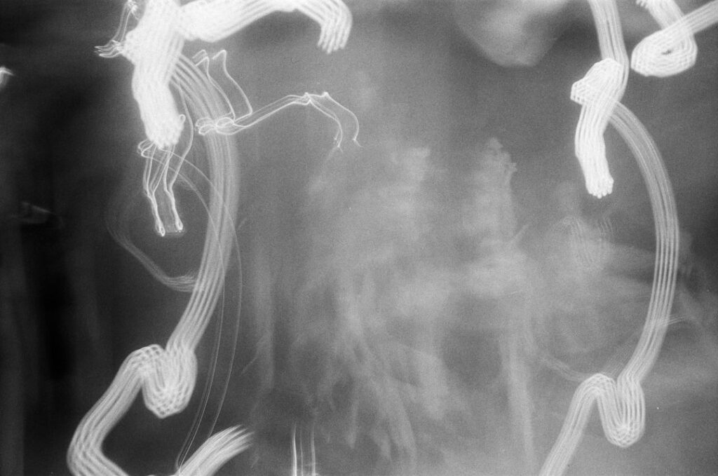 le syndrome vestibulaire est un trouble affectant l'équilibre et la coordination, causé par des problèmes au niveau de l'oreille interne ou du cerveau. découvrez ses symptômes, ses causes et les traitements disponibles.